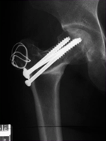 시술된 환자의 X-ray